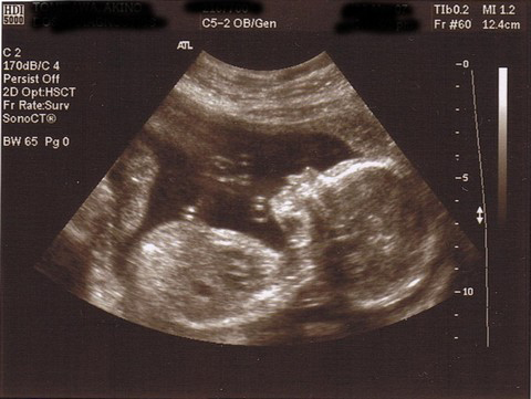 Ultrasound Baby Pictures on Your Ultrasound     Difference Between 2d  3d And 4d Ultrasounds