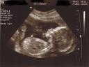 20 week baby, unknown gender