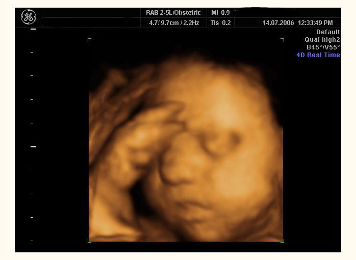 3d ultrasound pictures of twins. 3D ultrasound