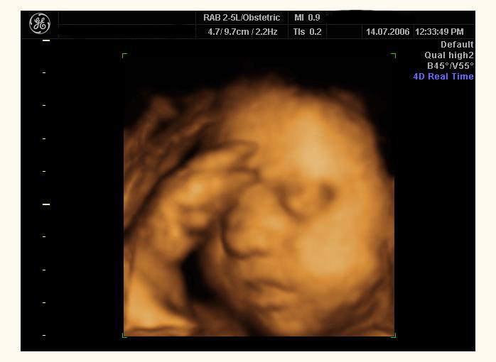 the first 3D ultrasound the first 3D ultrasound