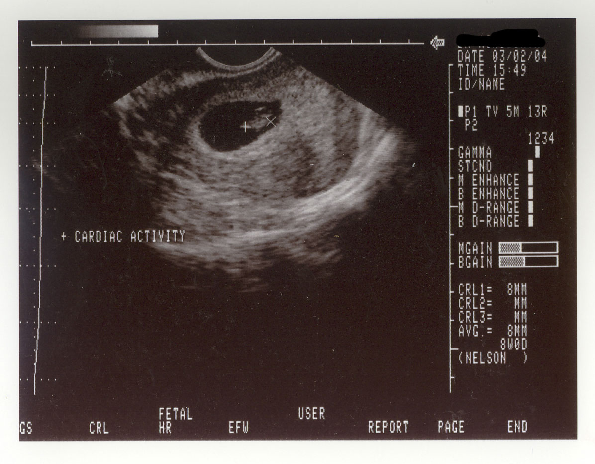 2D ultrasound at 8 weeks