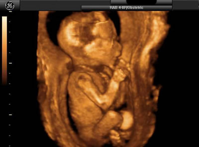 18 week boy baby 3D ultrasound