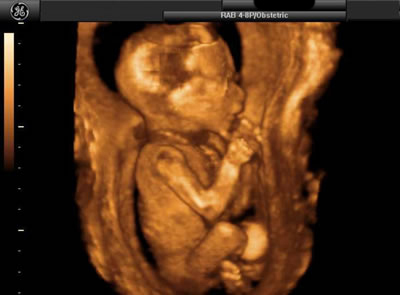 3D Ultrasound 18 Weeks