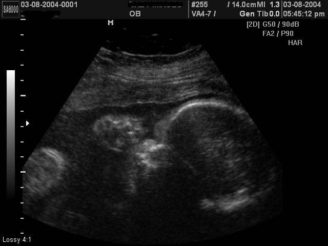 ultrasound images of girls and boys.  ultrasound images of a baby girl whose parents were told to expect a boy 