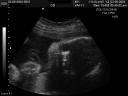 28 week girl ultrasound, thought to be boy