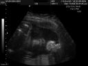 28 week girl ultrasound, not boy as predicted
