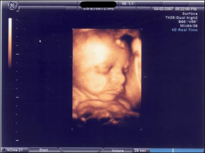 4D ultrasound, 28-week boy