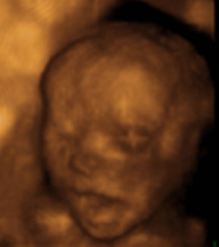 3D ultrasound of 22-week boy