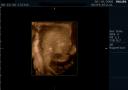 3D ultrasound of 24 week boy baby #3