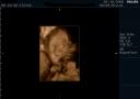3D ultrasound of 24 week boy baby #6