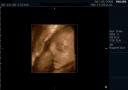 3D ultrasound of 24 week boy baby