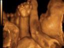 3D ultrasound of boy