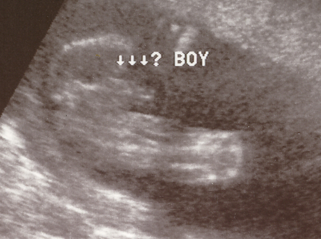 baby boy ultrasound featuring penis